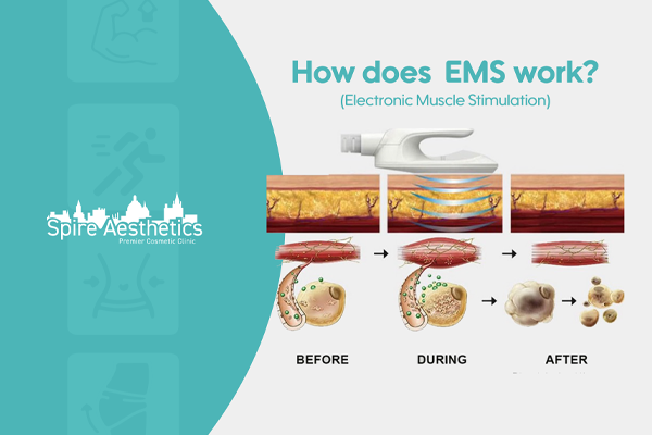 EMS treatment for post pregnancy weight loss treatment York