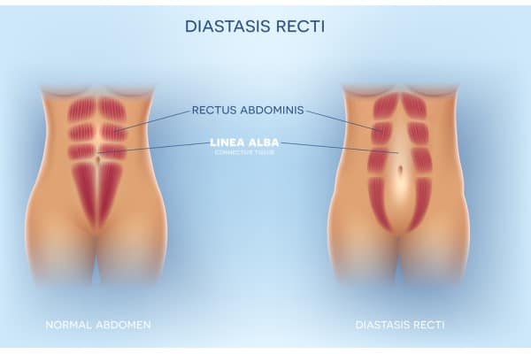What Non-Surgical Options Are Available for Diastasis Recti York?