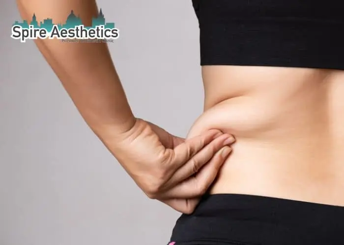Image of woman pinching fat on their hips York. Fat Freezing treatment
