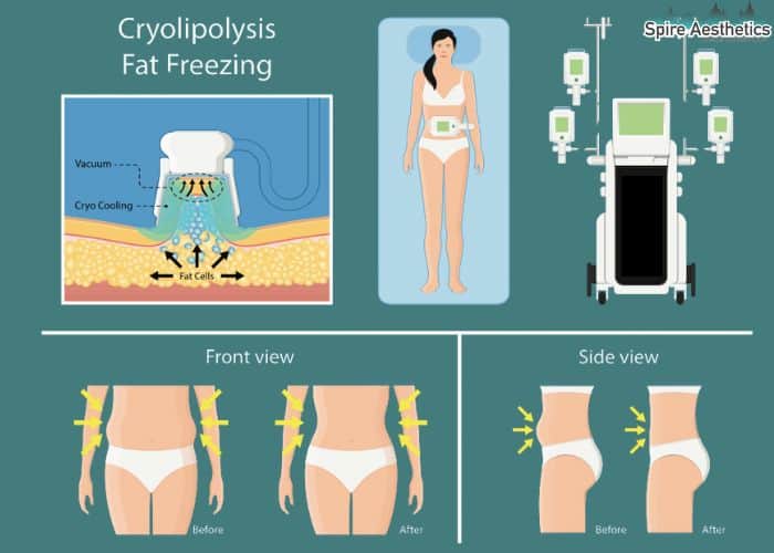 Image of diet and fat freezing combined for best results for Spire Aesthetics York