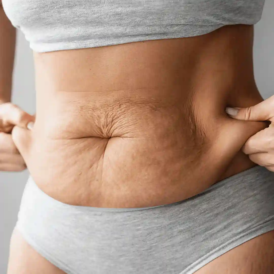 Is It Normal to Have Loose Skin After Pregnancy York?