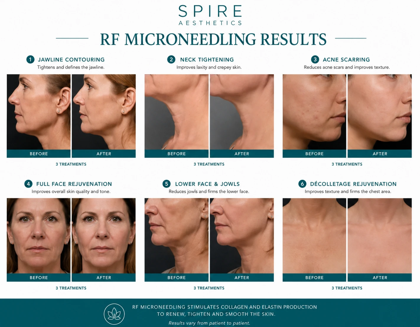 RF Microneedling Skin tightening York results