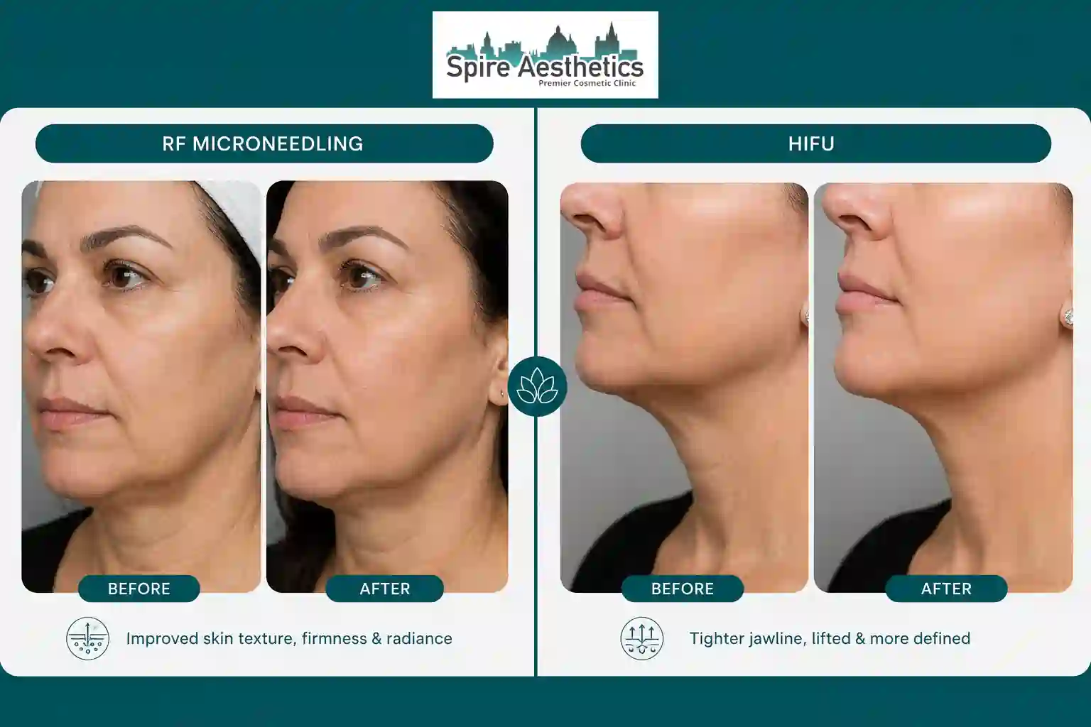 Can RF Microneedling and HIFU Be Combined York?