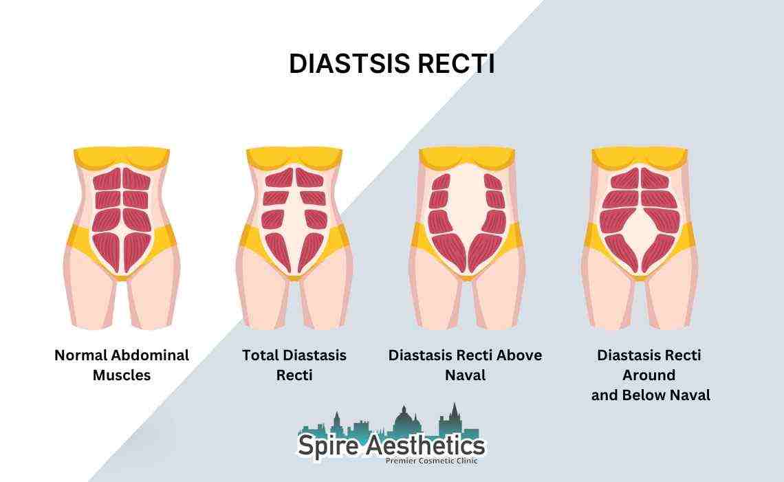Is Non-Surgical Diastasis Recti Treatment Right for You? Common Concerns Answered York